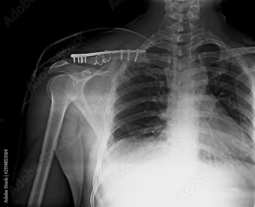 Fotografie Chest and shoulder X-ray showing surgical plate fixation with screws for clavicl