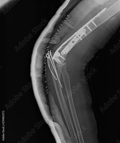 Obraz na plátne Lateral view elbow X-ray showing complex distal humerus locking plate fixation,