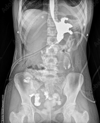 Fotografie Fluoroscopic barium swallow radiograph showing esophageal outline stomach fillin