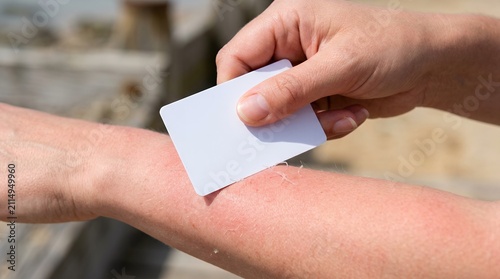 Person treating a jellyfish sting on arm. Using a card to remove tentacles from skin.