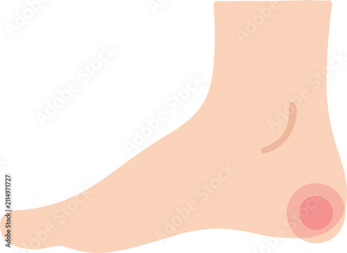 Quadro su tela Human foot with heel pain
