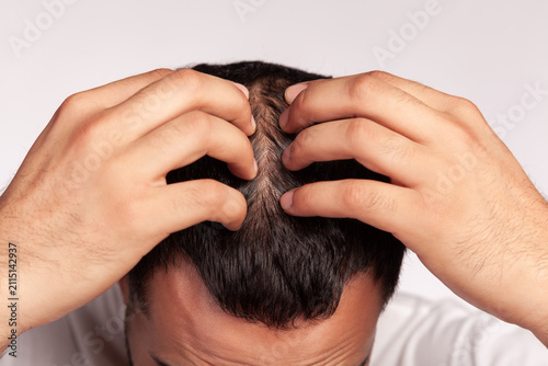 Close up of hands checking hair density on crown area to inspect scalp health and follicles during male pattern hair loss examination isolated over gray background