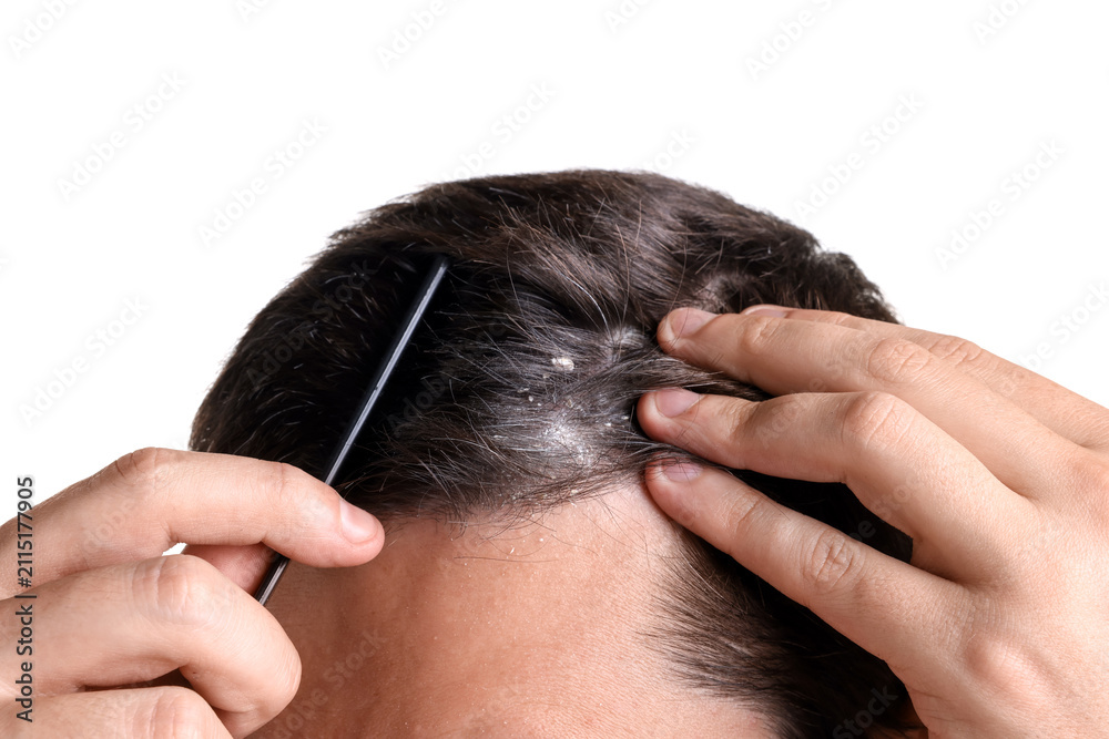Fototapeta premium Dandruff problem. Man with comb examining his head on white background, closeup