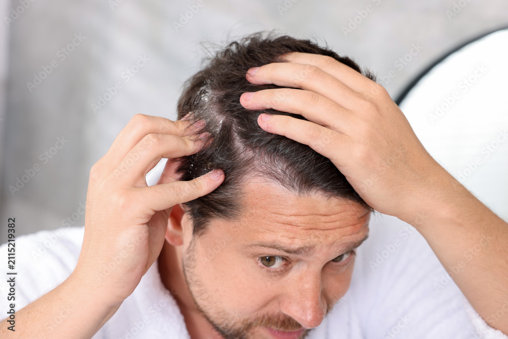 Fototapeta premium Dandruff problem. Worried man in bathrobe examining his head at home