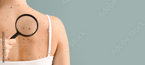 Dermatologist examining mol...