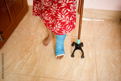 Broken leg