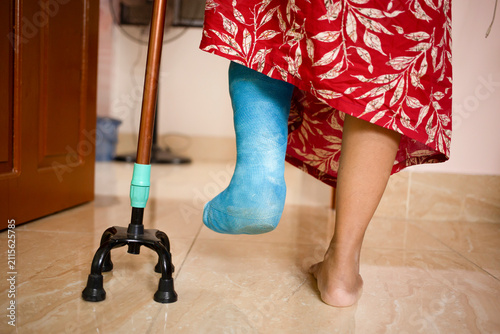 Broken leg