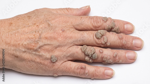 Obraz na płótnie Elderly Hand with Extensive Cauliflower Warts Spread Across Multiple Fingers and