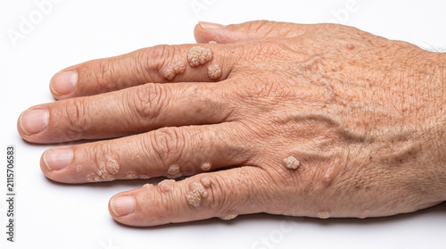 Foto Wrinkled Elderly Hand with Raised Cauliflower Warts on the Finger Knuckles and B