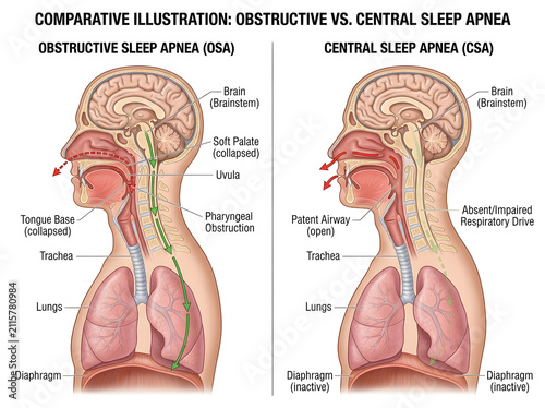 Obstructive vs central sleep apnea medical illustration isolated on white background