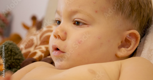Fotografie A young child is sitting at home with chickenpox