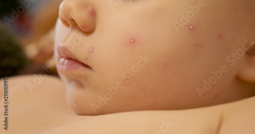 A child has chickenpox with blisters appearing on the face. The child is in a home setting. Parents may be concerned about the condition and its effects.