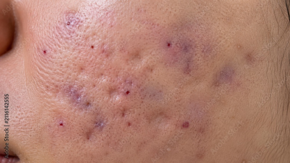 Fototapeta premium Close-up of human skin with severe acne scars and inflamed red pimples on cheek surface