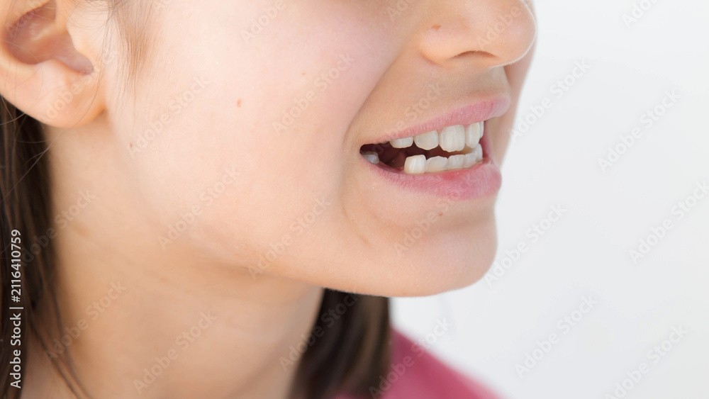 Fototapeta premium Closeup smiling young woman showing missing front tooth with healthy gums, natural skin, positive facial expression, dental care, orthodontic treatment, oral health, childhood dentistry concept