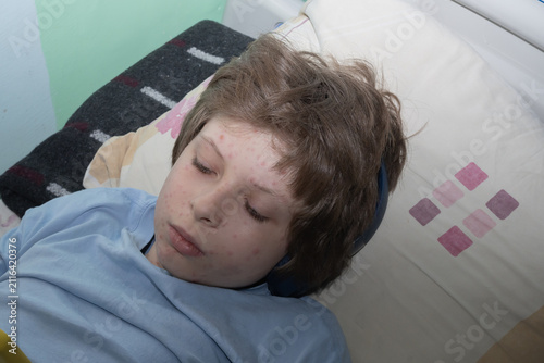 Bild auf Leinwand Child with chickenpox lesions on the face, neck and back demonstrating typical symptoms of varicella