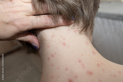 Foto Child with chickenpox lesions on the face, neck and back demonstrating typical symptoms of varicella
