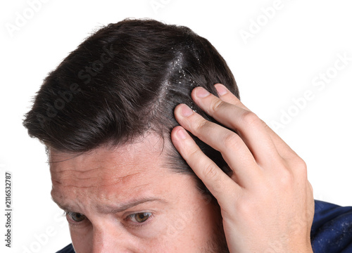 Fotografie Dandruff problem