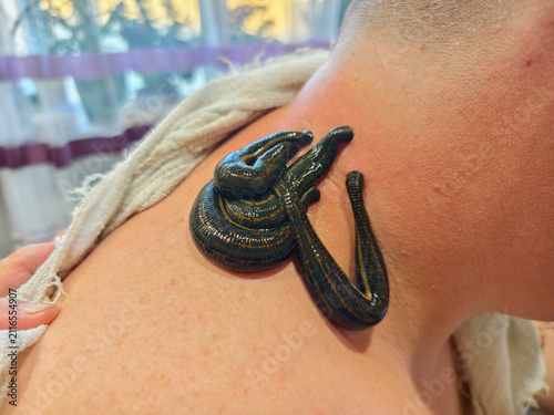 Canvastavla Medicinal leeches attaching to a person's neck for a natural hirudotherapy treatment, using a traditional alternative medicine approach for health and wellness