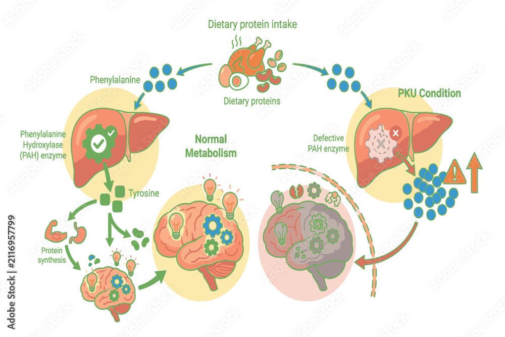 Naklejka premium Educational Phenylketonuria infographic explaining inherited metabolism disorder, newborn screening, neurological complications, diagnosis, and lifelong dietary therapy.
