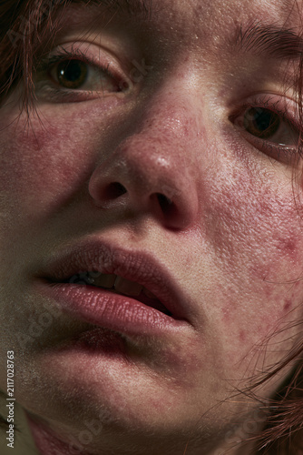 close up of scared female face with realistic blemishes or redness in rash, at night 