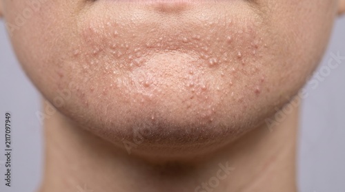 Close up of closed comedones and textured skin on female chin
