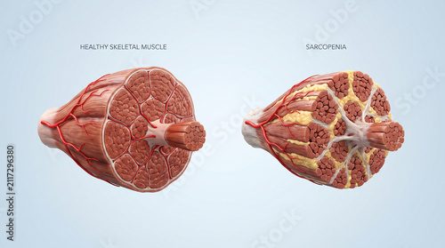 3D Anatomy Comparison of Healthy Muscle Tissue and Sarcopenia
