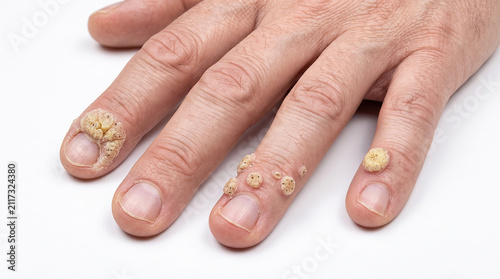 Принти на полотні Multiple rough, grainy warts clustered around the fingernails - Clustered Periun