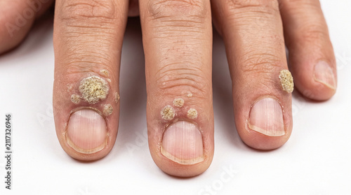 Photography Close-up of bumpy, rough warts surrounding the fingernails and cuticles  - Periu