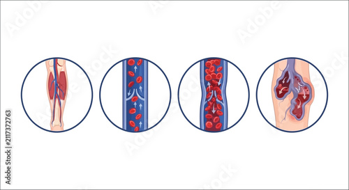 Obraz na płótnie Illustration of blood circulation stages within vessels depicting healthy to blo