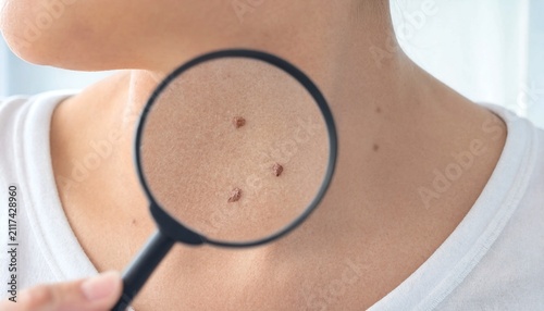 Person using a magnifying glass to inspect skin moles on neck