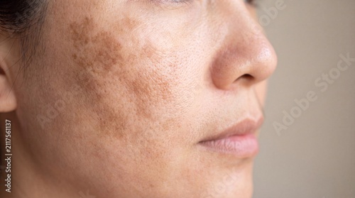 Woman with melasma brown patches on cheek closeup indoors  