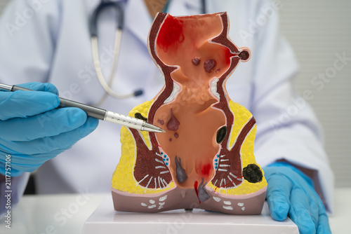 Картината върху платно Asian doctor with rectum and hemorrhoid human model, inflamed vascular structure