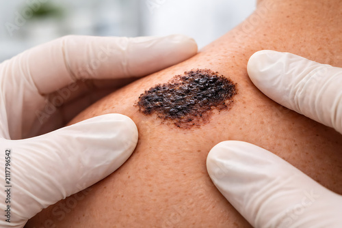 Gloved doctor examining healing skin lesion during clinical dermatology checkup and cancer screening