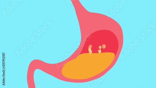 A 2D animation of a stomach with bubbles. Background for an advertisement for gastric bloating treatment. Food poisoning. Sorbents in the stomach.