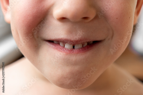 Child's smile. Child's teeth. Baby white teeth of a white-skinned person. Two permanent lower teeth. Even white teeth of a 5-year-old child.