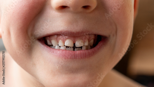 Child's smile. Child's teeth. Baby white teeth of a white-skinned person. Two permanent lower teeth. Even white teeth of a 5-year-old child.