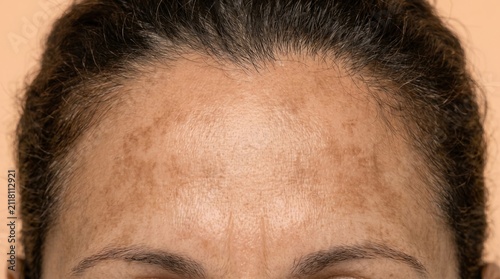 Close-up of female forehead showing melasma, hyperpigmentation, and uneven skin tone.