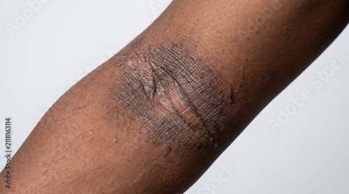 Close Up of Lichenification and Thickened Skin Lesion on Dark Skin Elbow