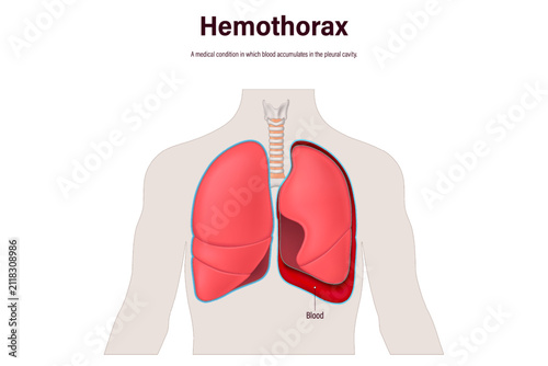 Hemothorax. Normal lung and lungs with blood in pleura space. Human respiratory system.