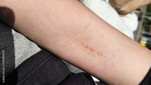 Close-up of a human wrist with a small red skin rash and tiny irritated spots in natural sunlight. Skin irritation, dermatology, allergy, sensitive skin, healthcare, and medical concept.