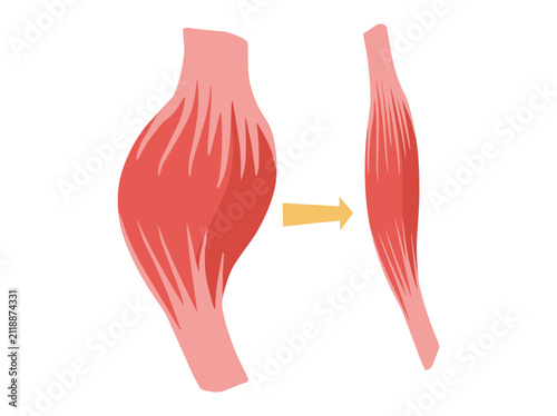 Normal Muscular and Dystrophy Atrophy