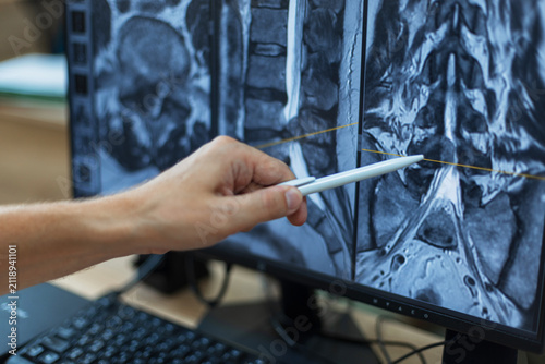 Cuadro en lienzo Doctor's hand pointing with a pen at a spine MRI scan on a computer screen, analyzing a vertebral hernia, back injury, or spinal cord pathology for medical diagnosis