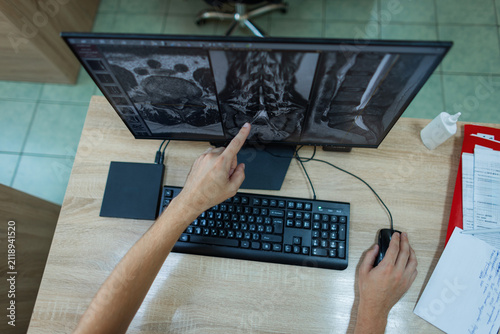 Obraz na płótnie top view of a radiologist examining a lumbar spine MRI scan on a computer monitor, pointing at a vertebral hernia during a diagnostic medical consultation