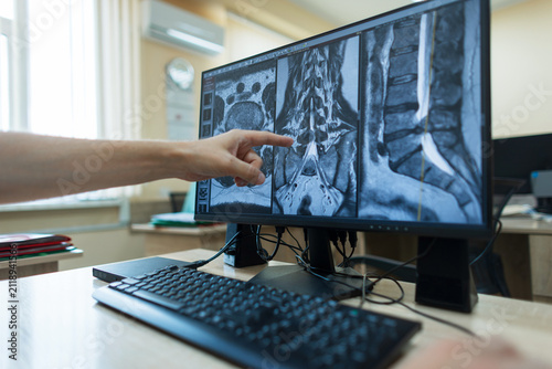 Obraz na płótnie hand points at a lumbar spine MRI scan on a computer monitor in a clinic, examining a vertebral hernia or spinal cord injury for a medical diagnosis