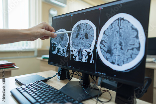 Obraz na plátně doctor points with a pen at a brain CT or MRI scan on a computer monitor, analyzing head trauma, stroke, neurological pathology for a medical diagnosis in clinic