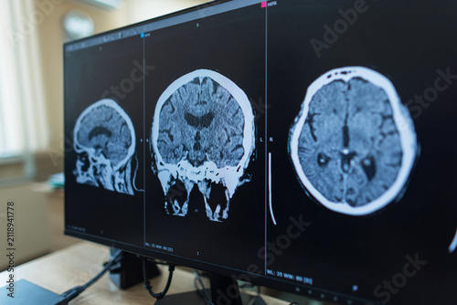 Quadro su tela A brain CT or MRI scan displayed on a professional computer monitor screen in a clinic, showing axial, sagittal, and coronal views for medical diagnosis of a head injury or stroke