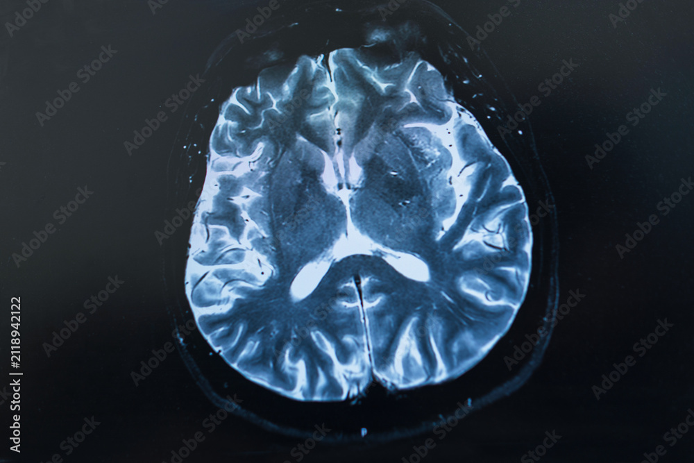 Obraz na płótnie A close-up shot of a human brain MRI or CT scan displayed on a monitor screen, showing detailed cross-section anatomy for medical diagnostics, neurology, and radiological analysis