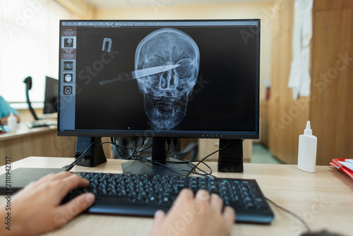 Quadro su tela A doctor or radiologist analyzes a shocking medical X-ray scan on a computer screen, showing a knife blade impaled inside a human skull from a severe head trauma or assault case