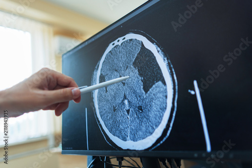 Foto A doctor's hand points with a pen at a computer screen displaying an axial brain CT scan with a large ischemic stroke, lesion, or cerebral infarction during a medical diagnosis review