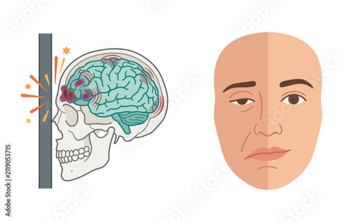 Concussion injury leading to facial droop and neurological trauma symptoms